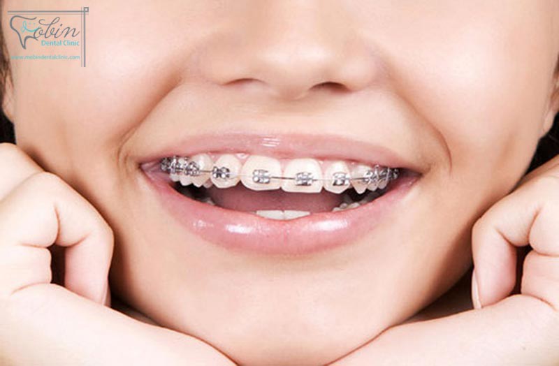 روش های نوین در ارتودنسی دندان کدامند؟